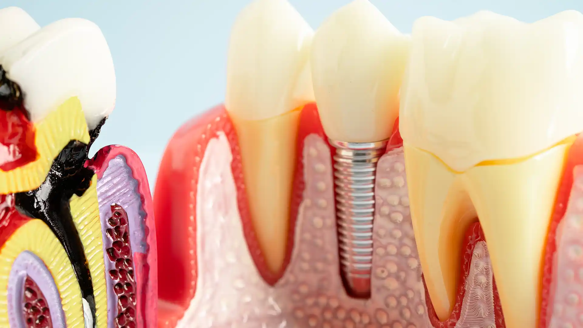  dental implants cost in Turkey
